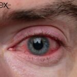 روزاسه چشمی: علل، علائم و روش های درمان